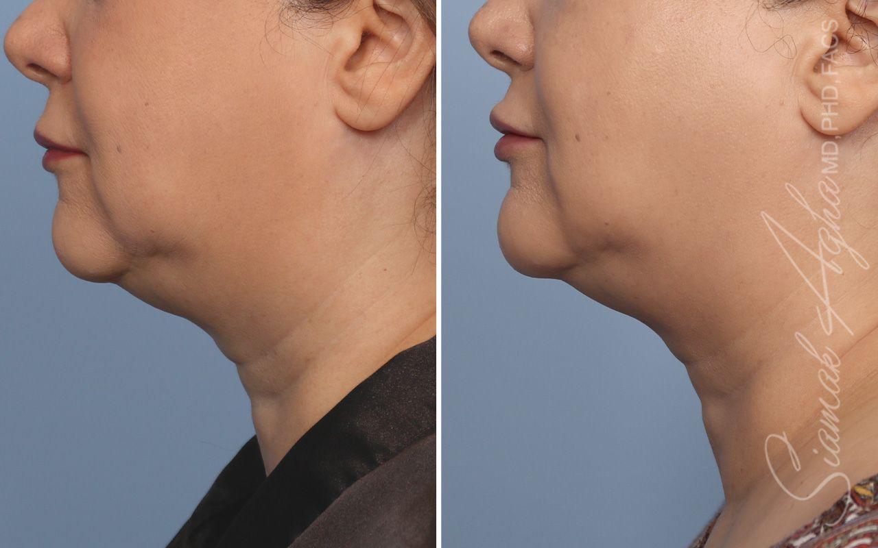 Ellacor Before & After