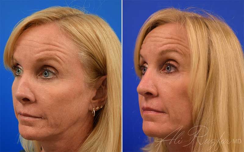 Revision Rhinoplasty Before & After