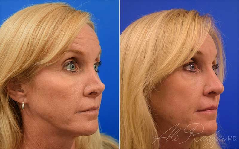 Revision Rhinoplasty Before & After