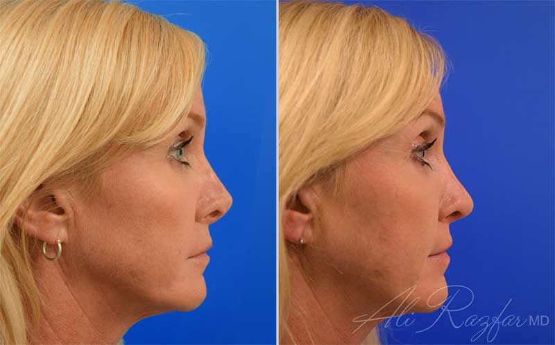 Revision Rhinoplasty Before & After