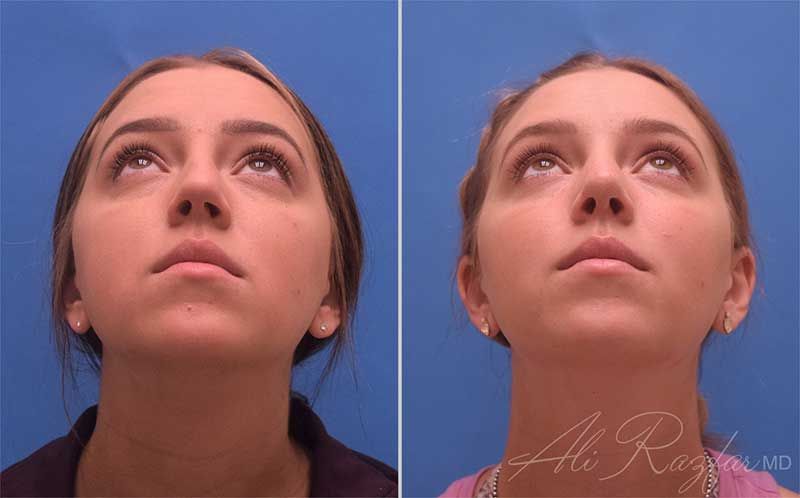 Revision Rhinoplasty Before & After