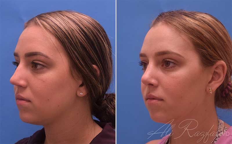 Revision Rhinoplasty Before & After