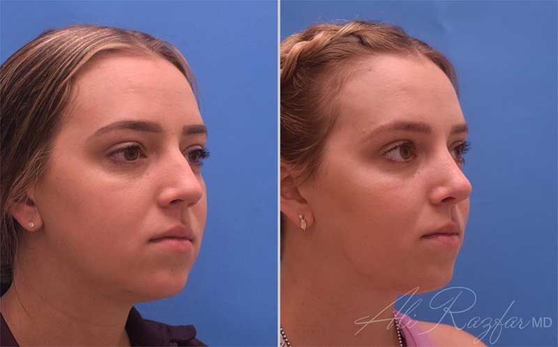 Revision Rhinoplasty Before & After