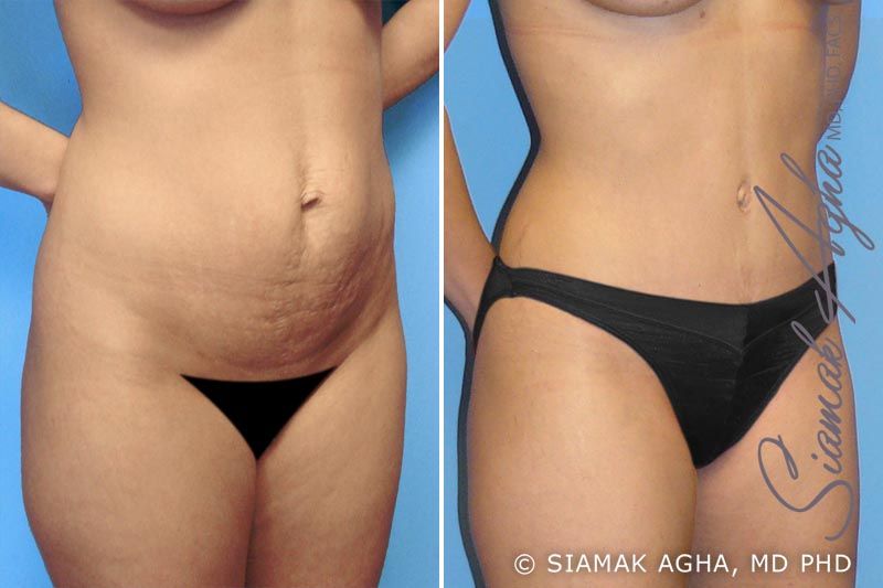 Tummy Tuck Before & After