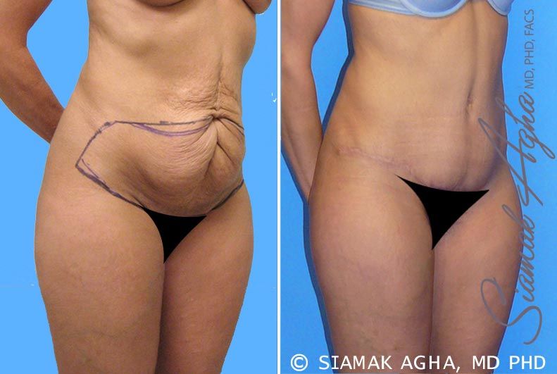 Tummy Tuck Before & After