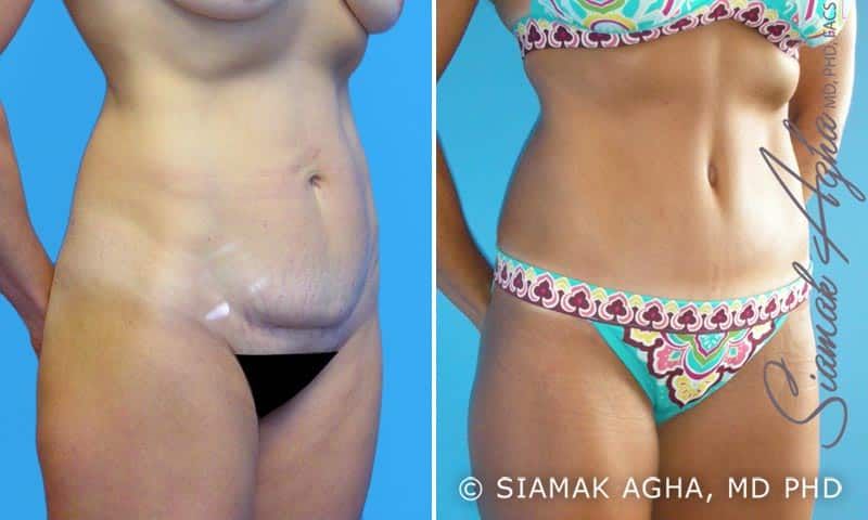 Tummy Tuck Before & After
