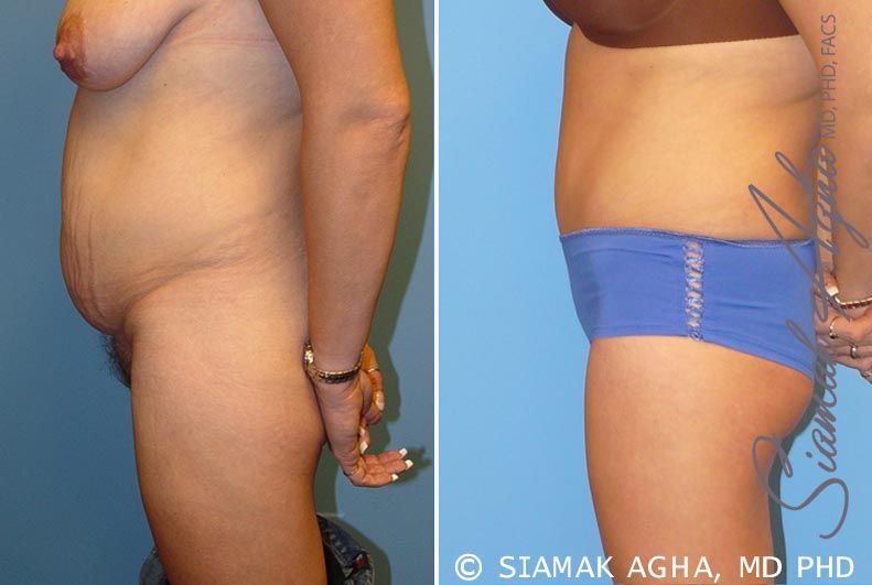 Tummy Tuck Before & After