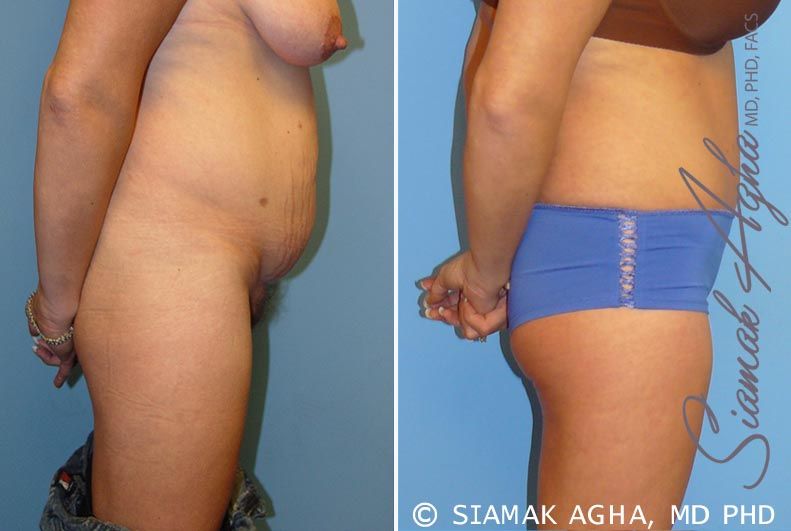 Tummy Tuck Before & After