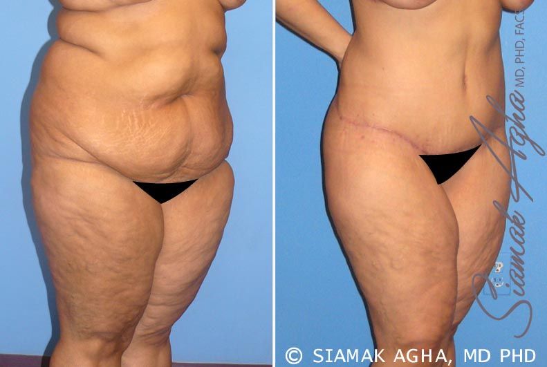 Tummy Tuck Before & After