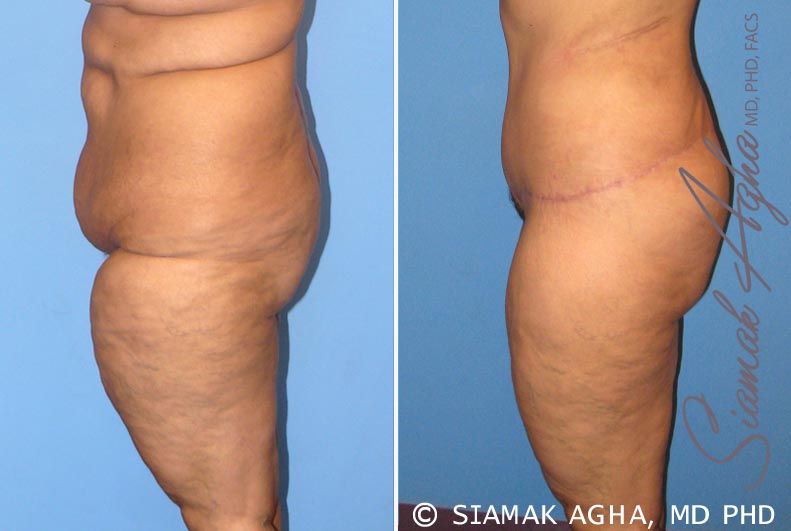 Tummy Tuck Before & After