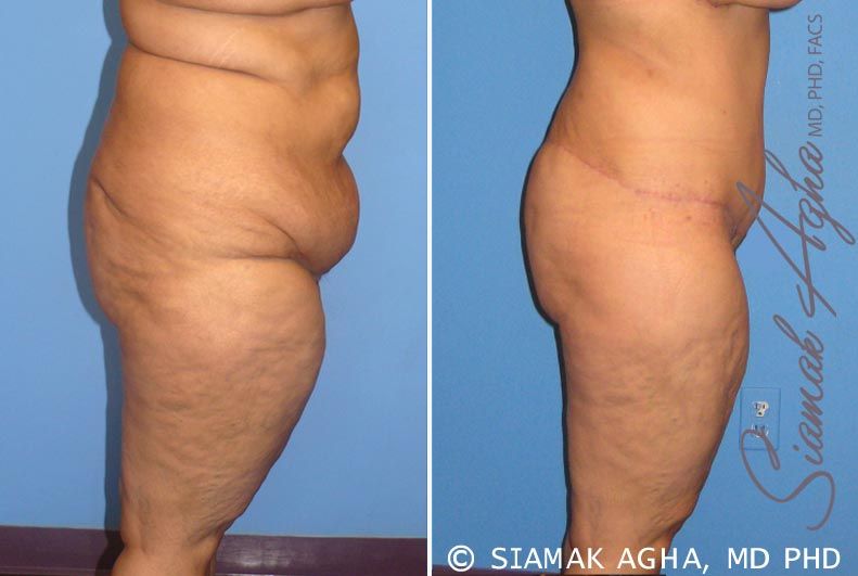 Tummy Tuck Before & After