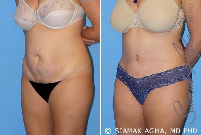 Tummy Tuck Before & After