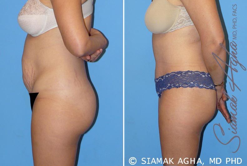 Tummy Tuck Before & After