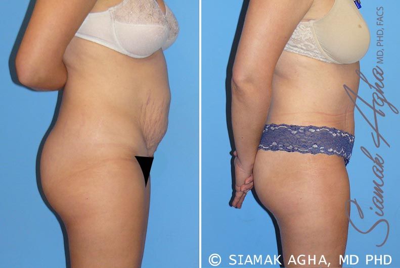 Tummy Tuck Before & After