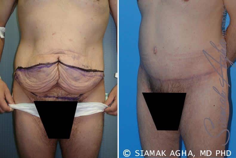 Tummy Tuck Before & After