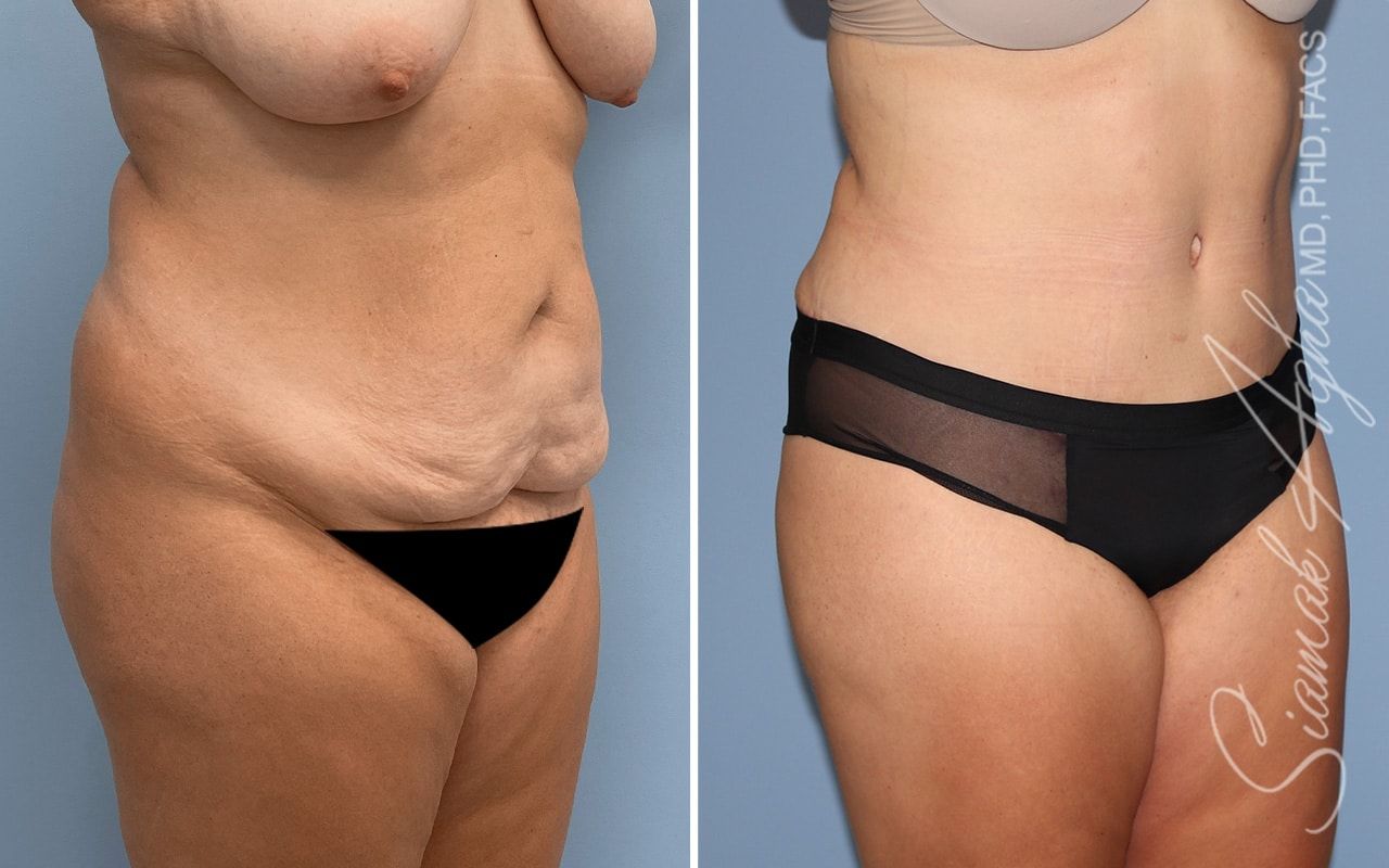Tummy Tuck Before & After