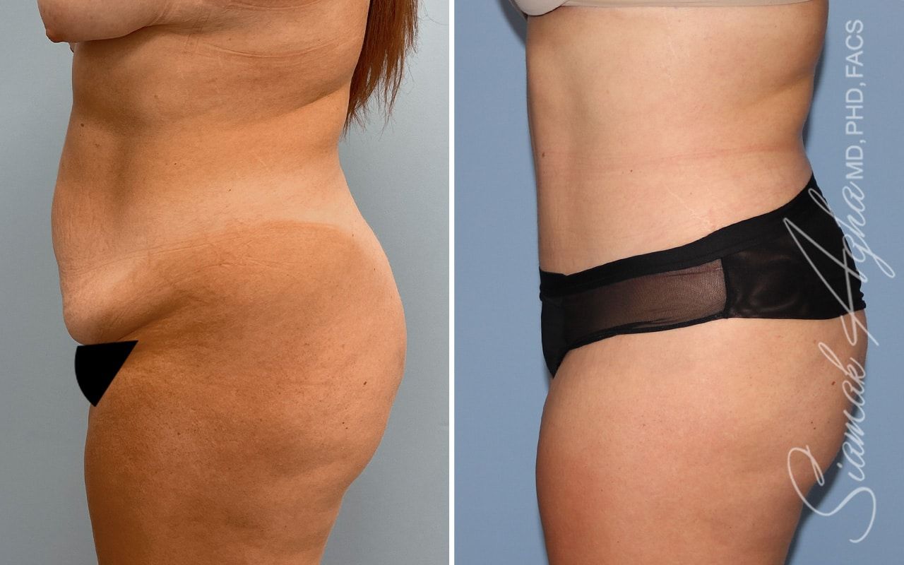 Tummy Tuck Before & After