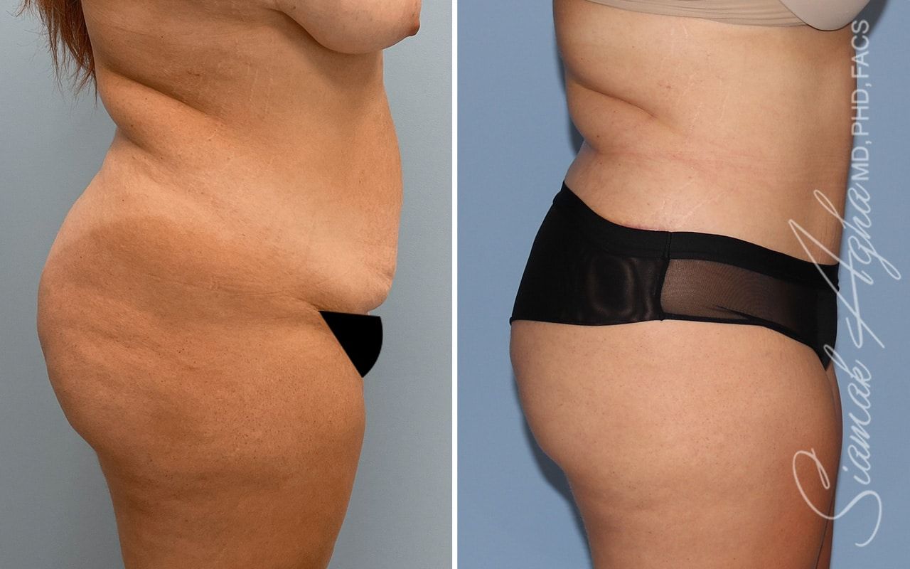 Tummy Tuck Before & After