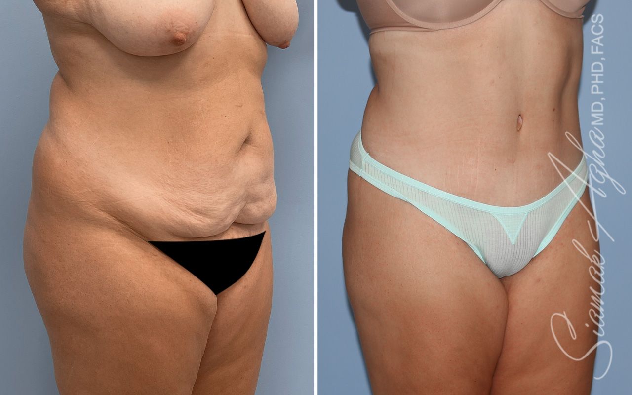Tummy Tuck Before & After