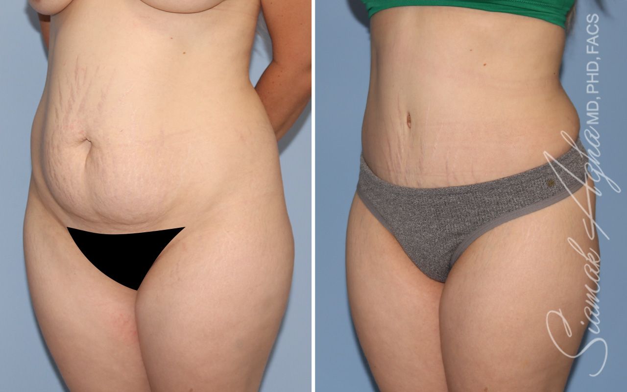 Tummy Tuck Before & After