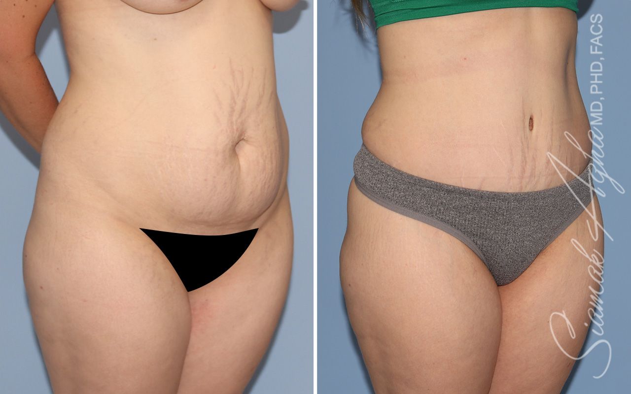 Tummy Tuck Before & After