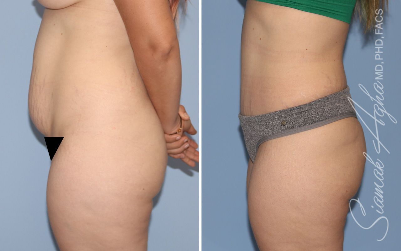 Tummy Tuck Before & After