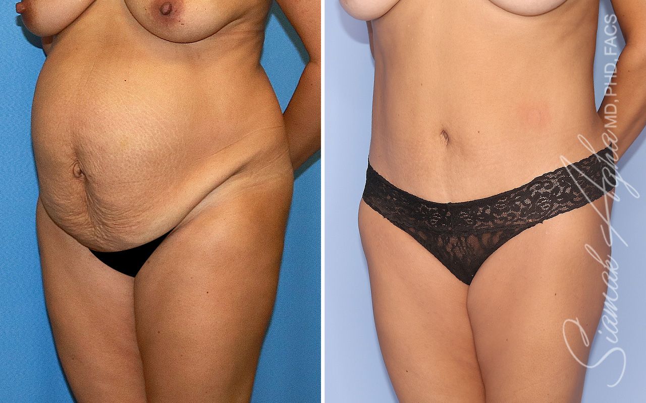 Tummy Tuck Before & After