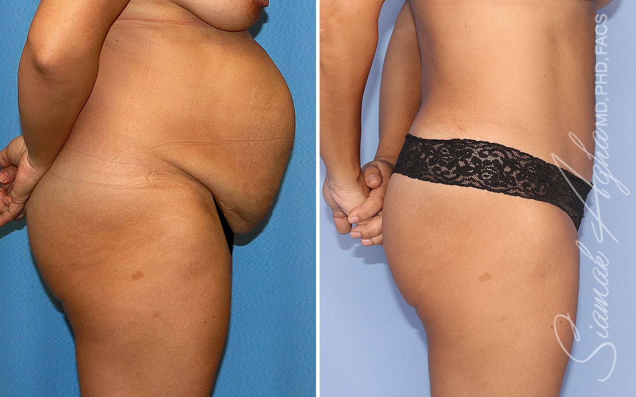 Tummy Tuck Before & After