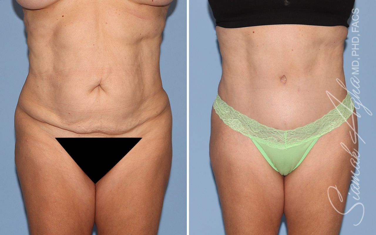 Tummy Tuck Before & After