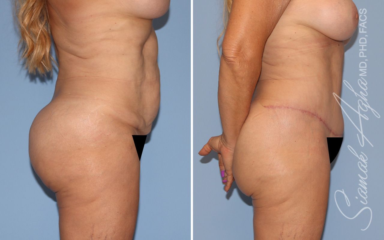 Tummy Tuck Before & After