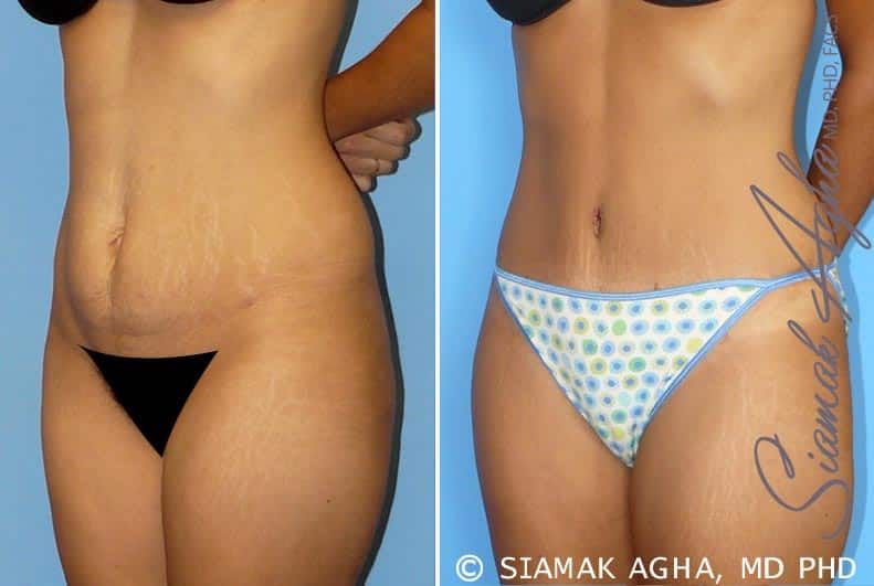 Tummy Tuck Before & After