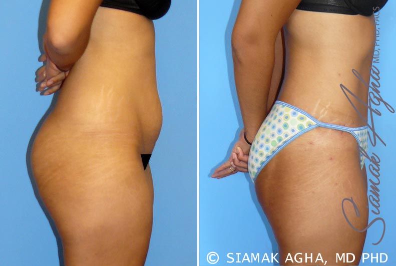 Tummy Tuck Before & After