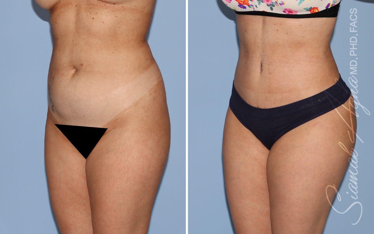 Tummy Tuck Before & After