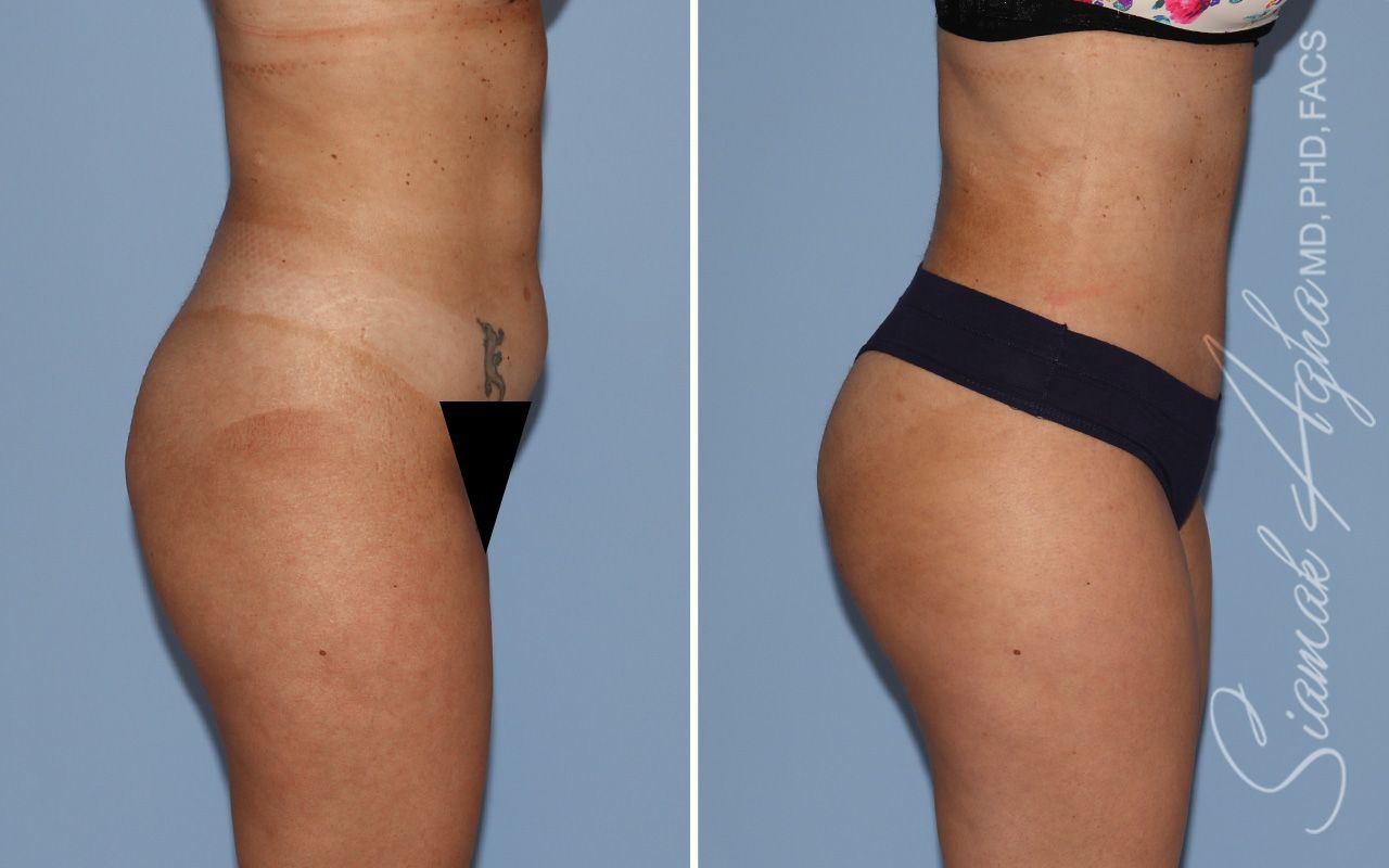 Tummy Tuck Before & After