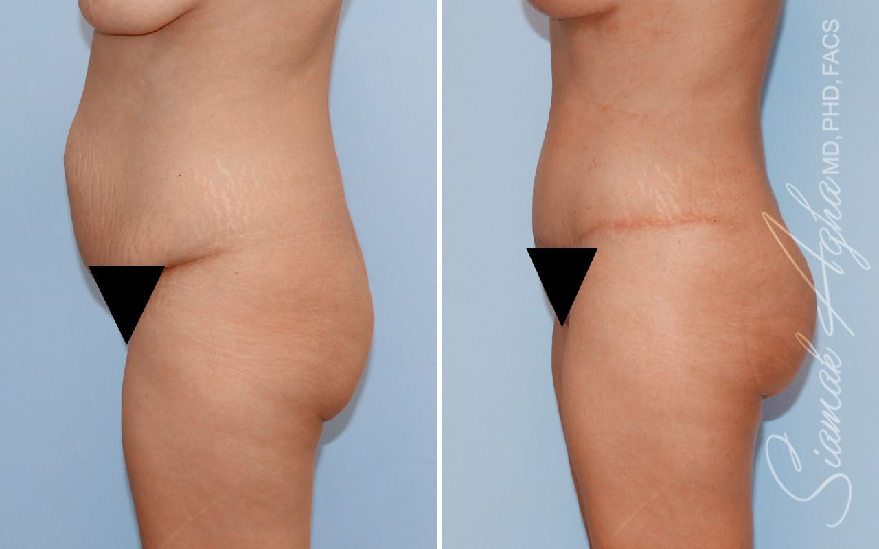 Tummy Tuck Before & After