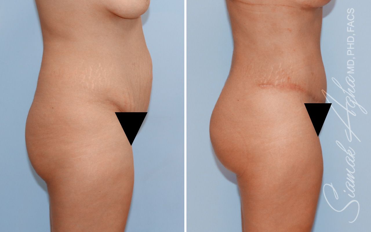 Tummy Tuck Before & After