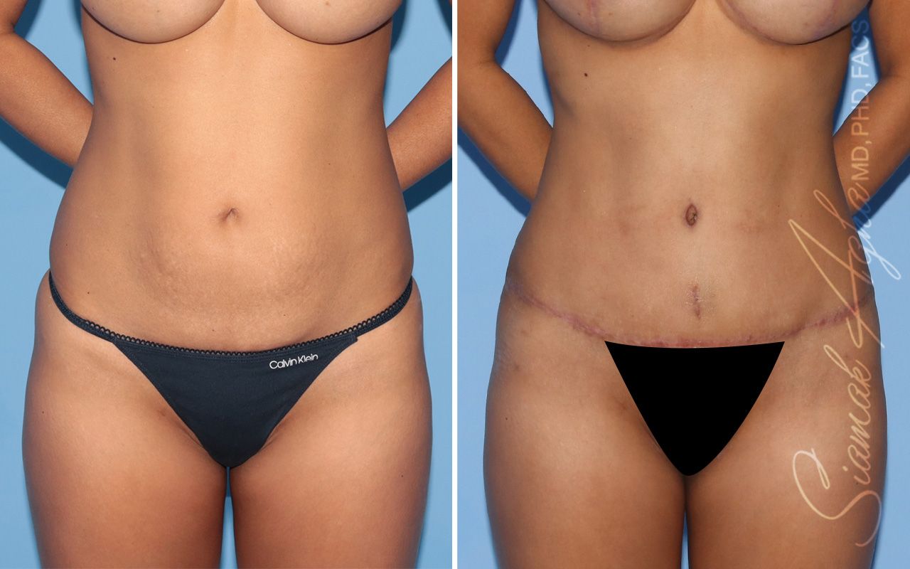 Tummy Tuck Before & After