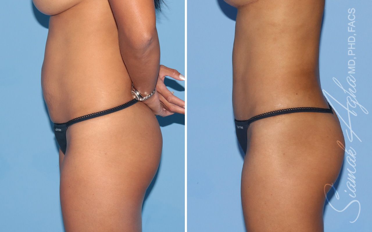 Tummy Tuck Before & After