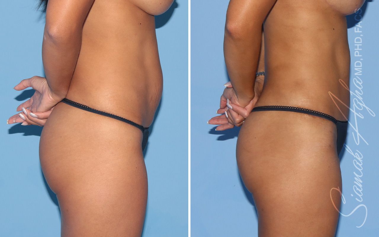 Tummy Tuck Before & After