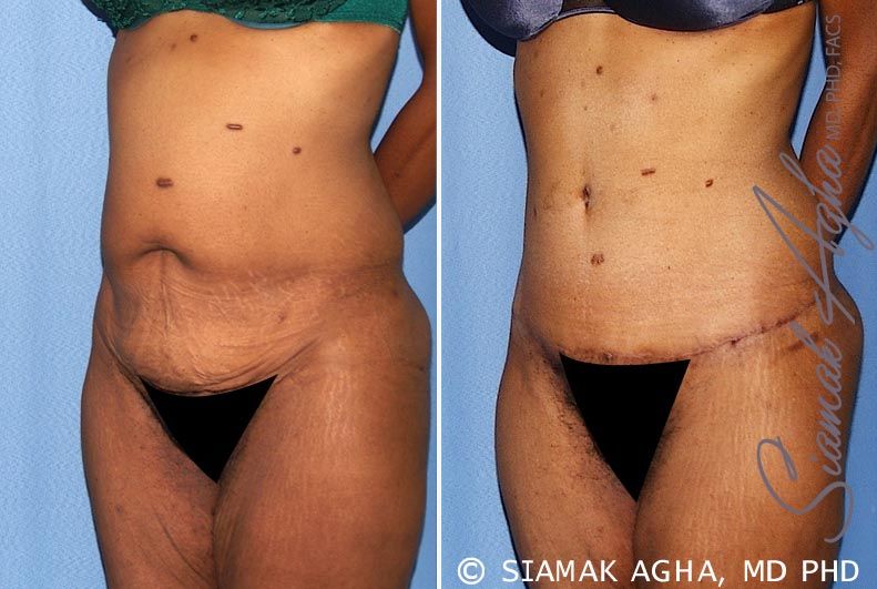Tummy Tuck Before & After