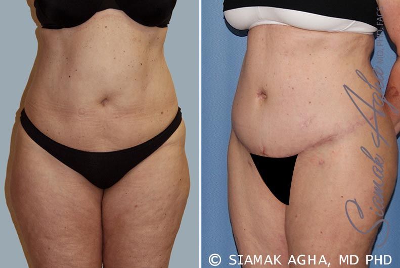 Tummy Tuck Before & After