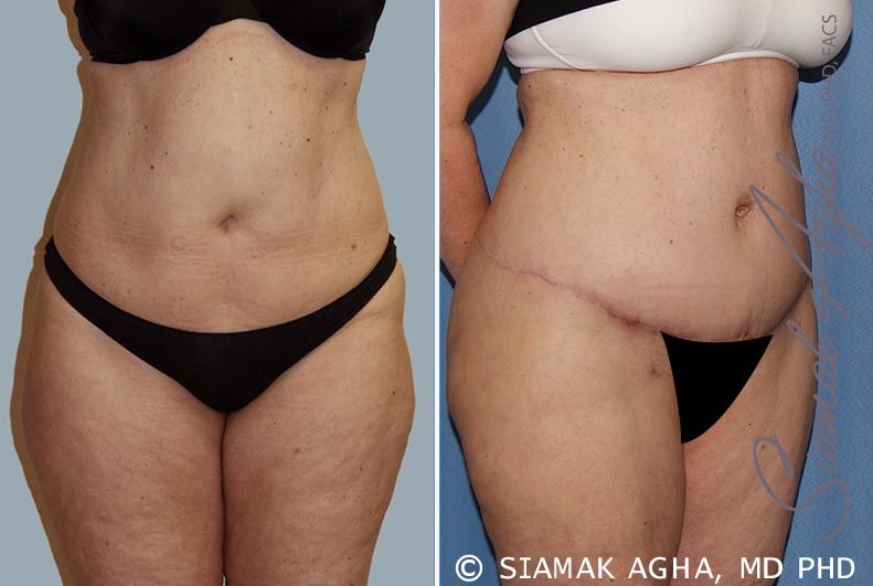Tummy Tuck Before & After