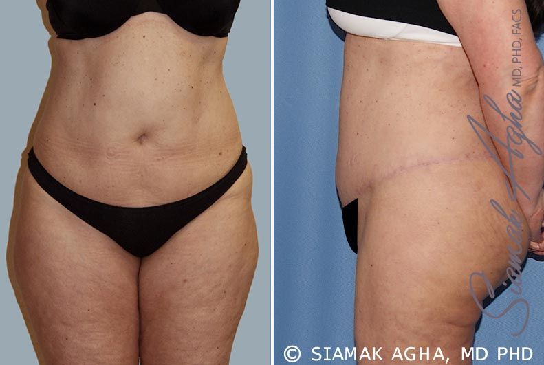 Tummy Tuck Before & After