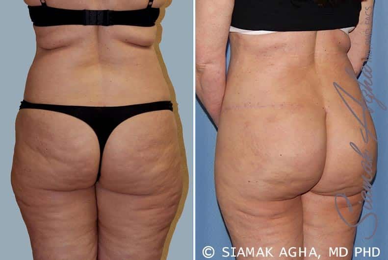 Tummy Tuck Before & After