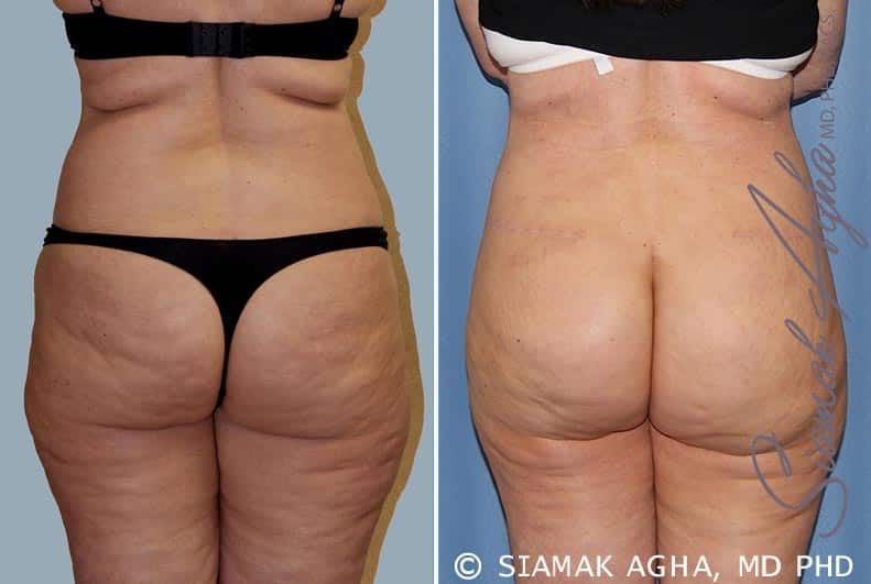 Tummy Tuck Before & After