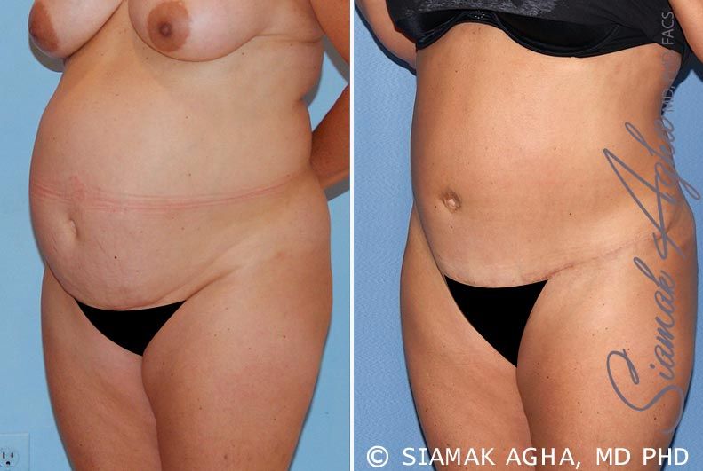 Tummy Tuck Before & After