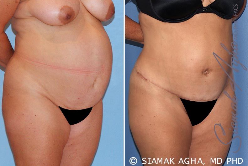 Tummy Tuck Before & After