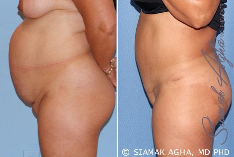 Tummy Tuck Before & After