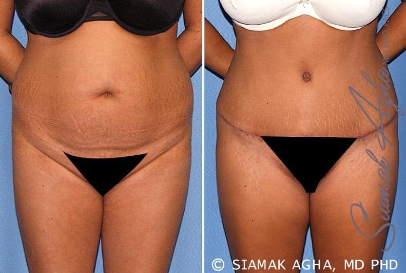 Tummy Tuck Before & After