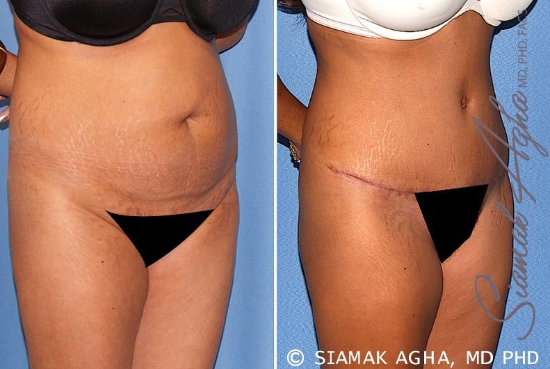 Tummy Tuck Before & After